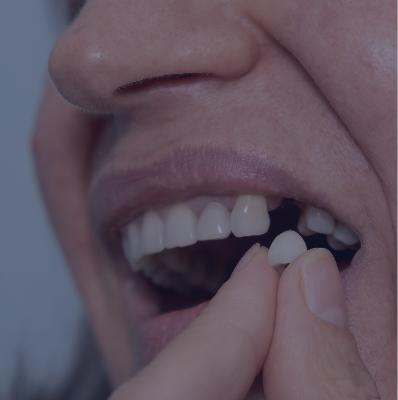 Dental veneer placement process