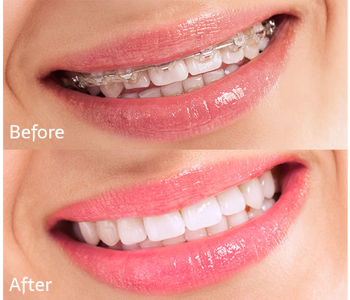 Teeth alignment progress with braces