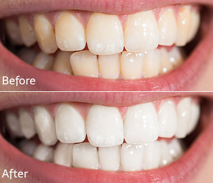Dental transformation with whiter teeth