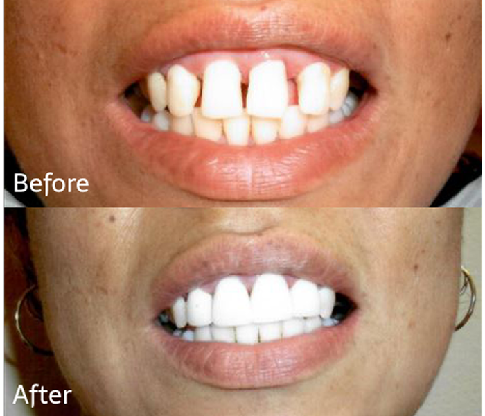 Smile transformation with dental work