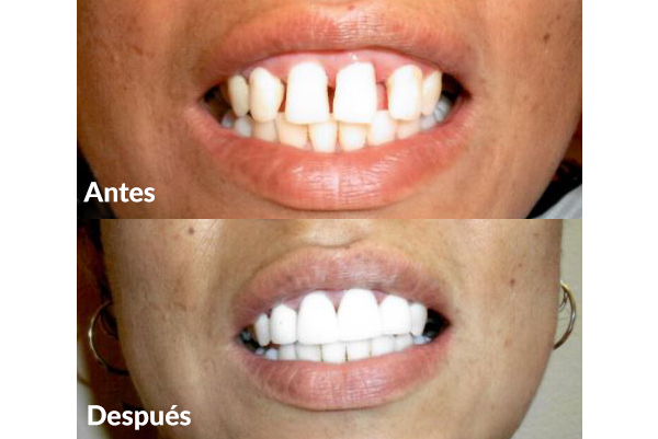 antes y despues de procedimiento dental de coronas