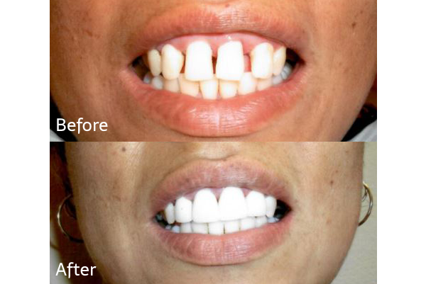 before and after of crown dental procedure