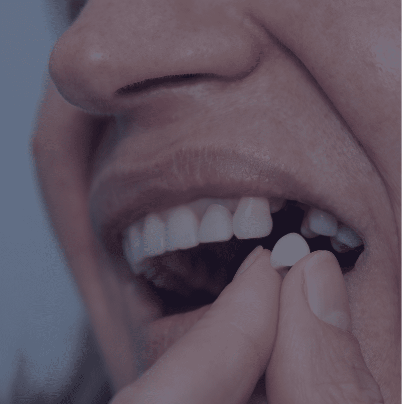 Dental veneer placement process
