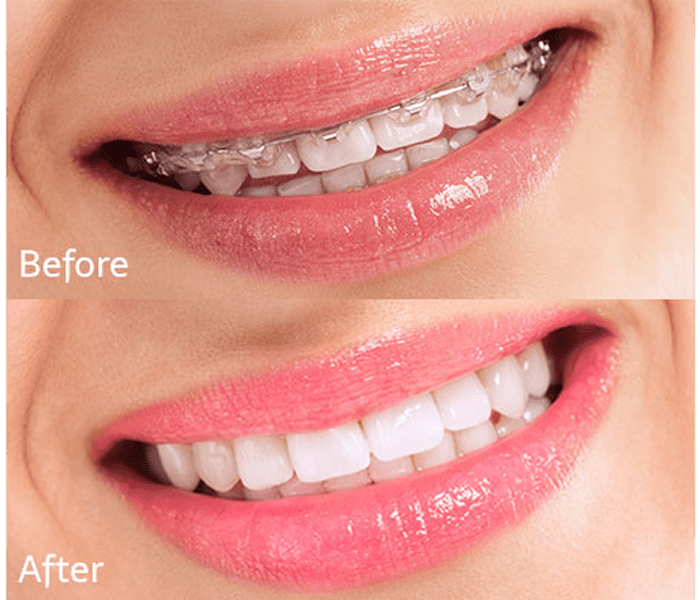 Teeth alignment progress with braces