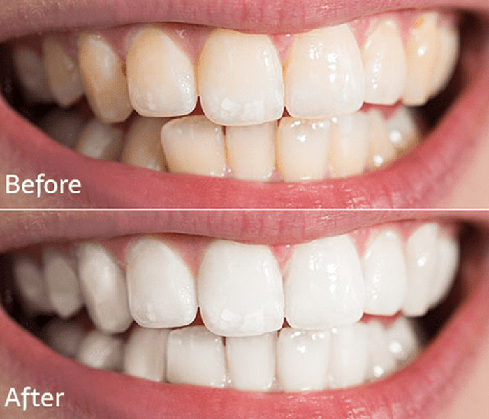 Dental transformation with whiter teeth