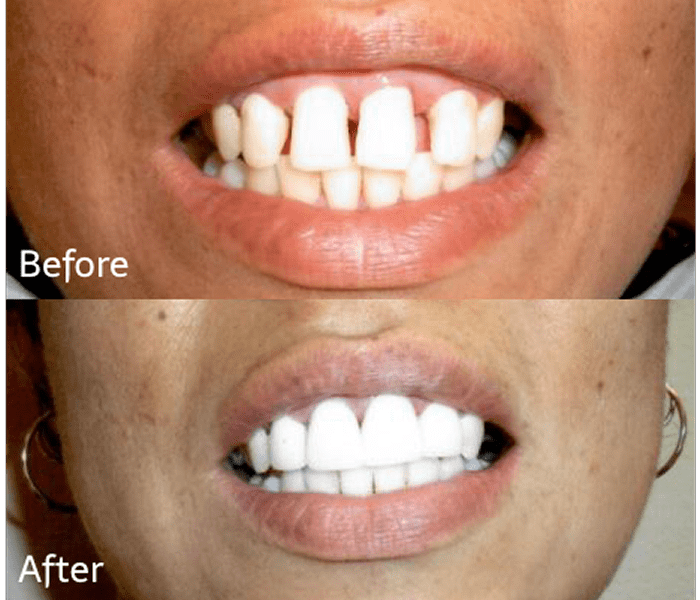 Smile transformation with dental work