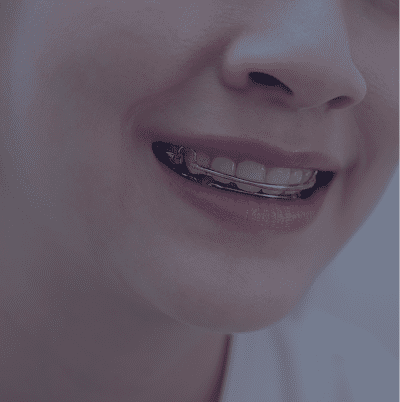 Close-up of smile wearing clear dental aligner