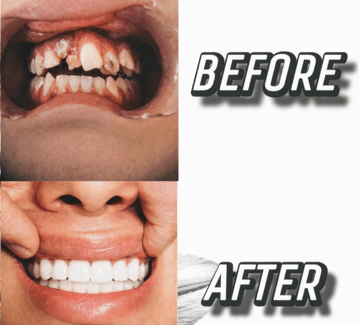 Severe tooth decay before and after restoration