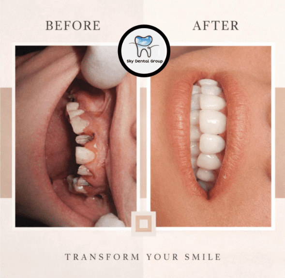 Before and after dental smile transformation