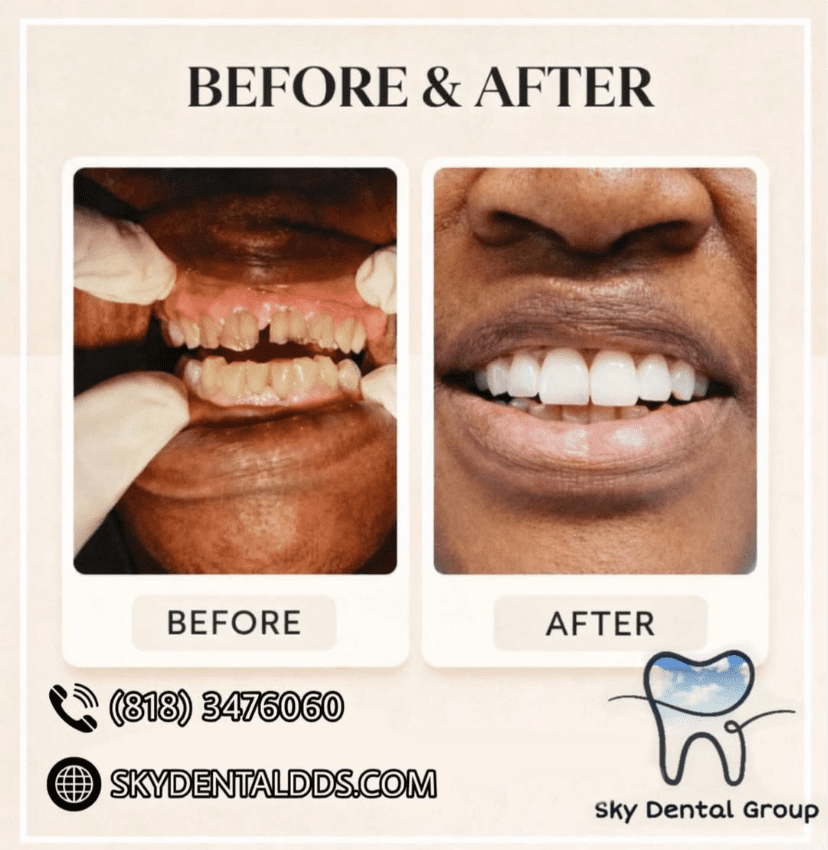 Before and after dental smile makeover