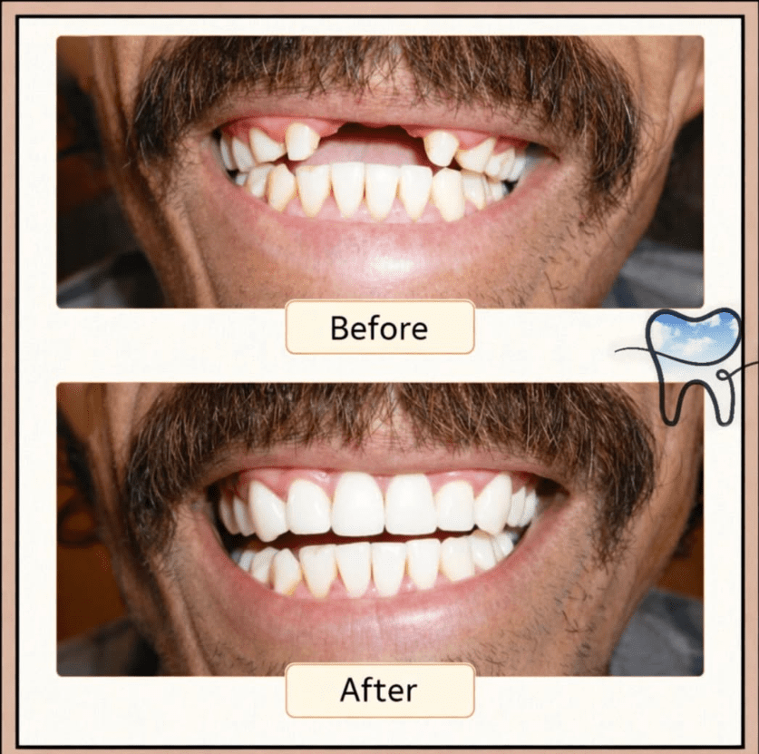 Before and after dental smile transformation